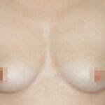 breast augmentation before and after, Breast Augmentation