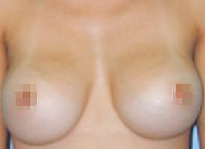 breast augmentation, Breast Augmentation