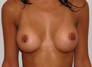 breast augmentation before and after, Breast Augmentation