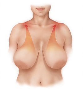 Series of images for Dr. Horndeski breast surgery. Includes a before state for both mastoplexy and reduction, phase 01, 02 and 03 of procedure, and patient after surgery.