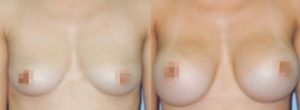 breast augmentation, What Does Breast Augmentation Cost?