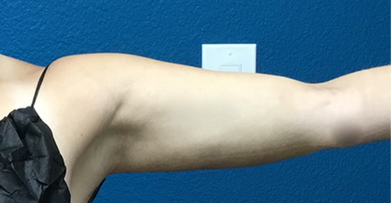 , Liposuction &#8211; Arms