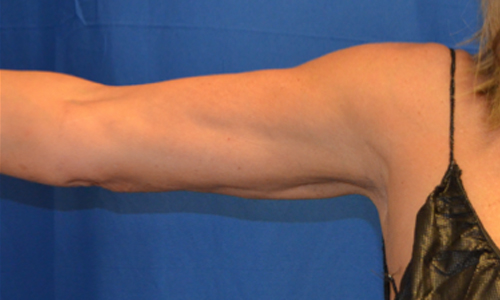 , Liposuction &#8211; Arms
