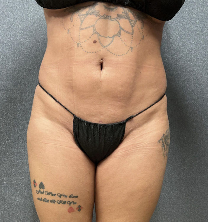 Liposuction Patient 46