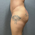 Liposuction Patient 56