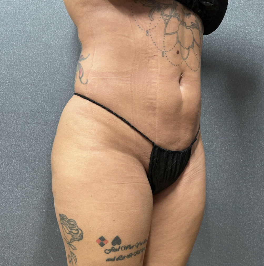 Liposuction Patient 53
