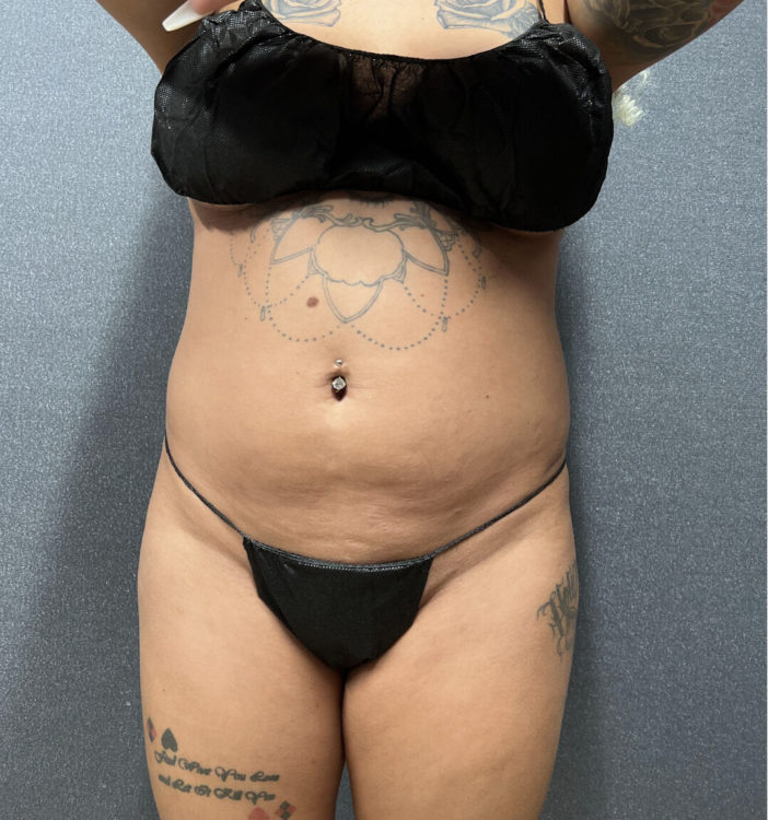 Liposuction Patient 46