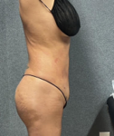 Liposuction Patient 58