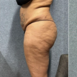 brazilian butt lift before and after, Brazilian Butt Lift