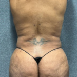 brazilian butt lift before and after, Brazilian Butt Lift