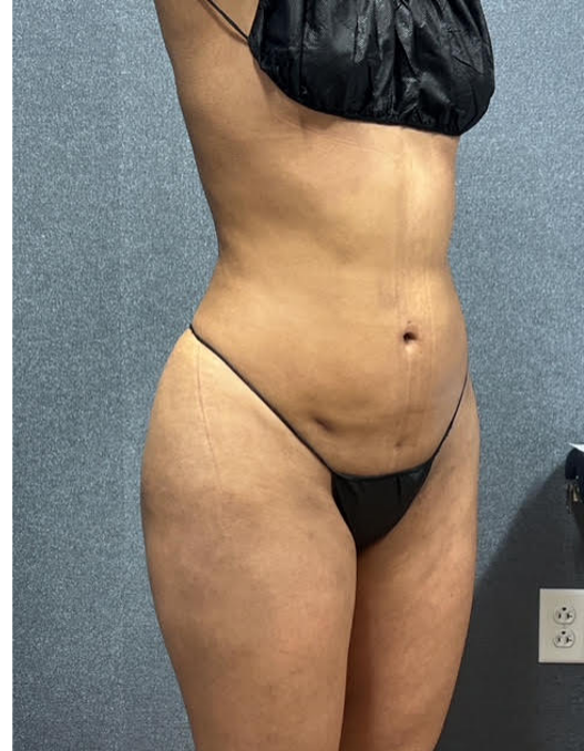 LIPO 360 RGT QTR AFTER