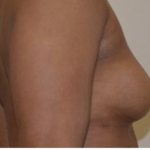 , Breast Augmentation with Fat Transfer