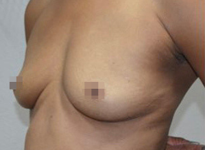 fat transfer breast augmentation, Breast Augmentation with Fat Transfer
