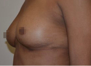 fat transfer breast augmentation