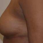 , Breast Augmentation with Fat Transfer