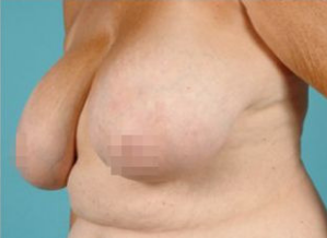 breast reduction before and after, Breast Reduction