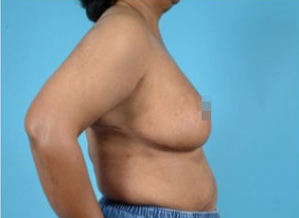 breast reduction before and after, Breast Reduction