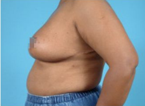 breast reduction, Breast Reduction